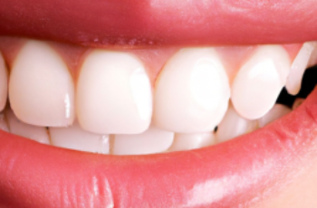 Understanding the Risks of Laser Teeth Whitening